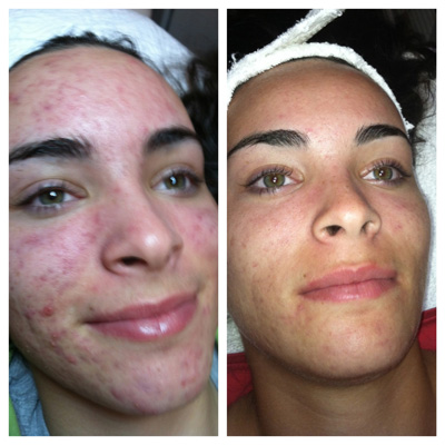 before-and-after-acne